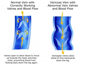 varicose dendrite definition