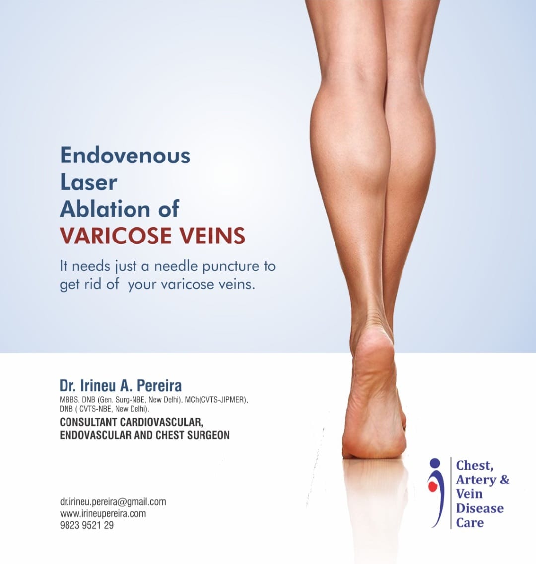 Simple Steps to Prevent Varicose Veins? - Vascular Health